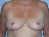 Patient # 21102 After Photo # 2