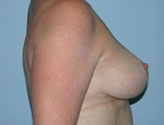 Patient # 21102 After Photo # 4