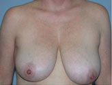 Patient # 21102 Before Photo # 1
