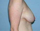 Patient # 21102 Before Photo # 3