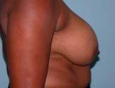 Patient # 64671 Before Photo # 3
