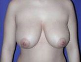 Patient # 62896 Before Photo # 1