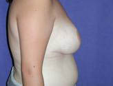 Patient # 41209 After Photo # 4