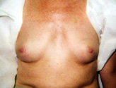 Patient # 32237 Before Photo # 1