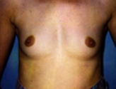Patient # 24579 Before Photo # 1
