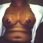 Patient # 11613 After Photo # 2