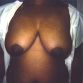 Patient # 11613 Before Photo # 1