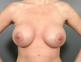 Patient # 71808 After Photo # 2