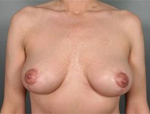 Patient # 56438 After Photo # 2