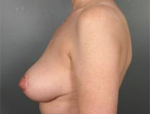 Patient # 56438 After Photo # 4