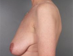 Patient # 56438 Before Photo # 3