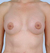 Patient # 11846 After Photo # 2