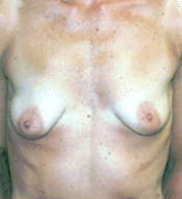 Patient # 67157 Before Photo # 1