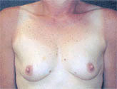 Patient # 47043 Before Photo # 1