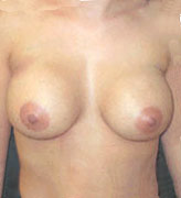 Patient # 71192 After Photo # 2