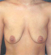 Patient # 71192 Before Photo # 1