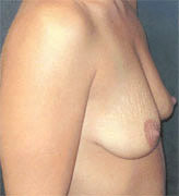 Patient # 71192 Before Photo # 3