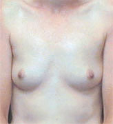 Patient # 68362 Before Photo # 1