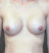 Patient # 71535 After Photo # 2