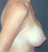 Patient # 39965 After Photo # 4