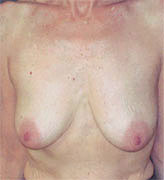 Patient # 39965 Before Photo # 1