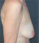 Patient # 39965 Before Photo # 3