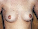 Patient # 54162 Before Photo # 1