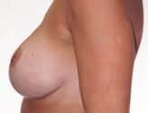 Patient # 55808 After Photo # 6