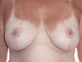Patient # 33525 After Photo # 2