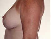 Patient # 33525 After Photo # 6