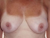Patient # 33525 Before Photo # 1