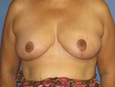 Patient # 19819 After Photo # 2