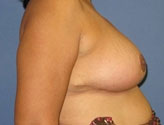 Patient # 19819 After Photo # 4