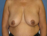 Patient # 19819 Before Photo # 1