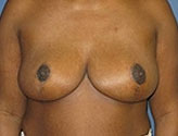Patient # 41823 After Photo # 2