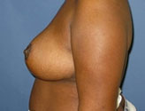 Patient # 41823 After Photo # 4