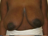 Patient # 41823 Before Photo # 1