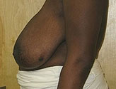 Patient # 41823 Before Photo # 3