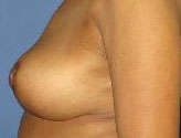 Patient # 16876 After Photo # 4