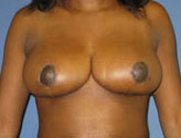 Patient # 96353 After Photo # 2