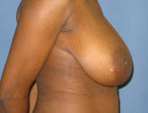 Patient # 96353 Before Photo # 3