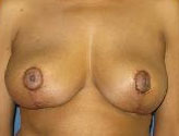 Patient # 82783 After Photo # 2