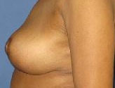 Patient # 82783 After Photo # 4
