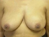 Patient # 82783 Before Photo # 1