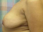 Patient # 82783 Before Photo # 3