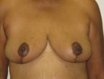 Patient # 68317 After Photo # 2