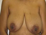 Patient # 68317 Before Photo # 1
