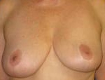 Patient # 52565 Before Photo # 1