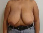 Patient # 49980 Before Photo # 1