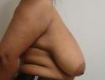 Patient # 49980 Before Photo # 3